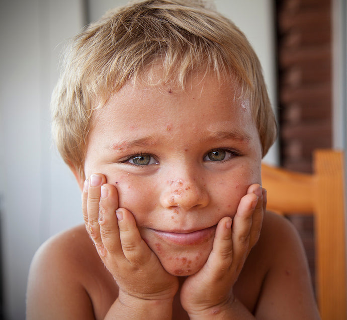 Cómo evoluciona la dermatitis atópica en un niño