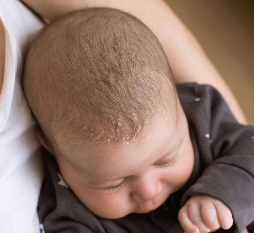 ¿Qué es la costra láctea y cómo afecta a mi bebé?