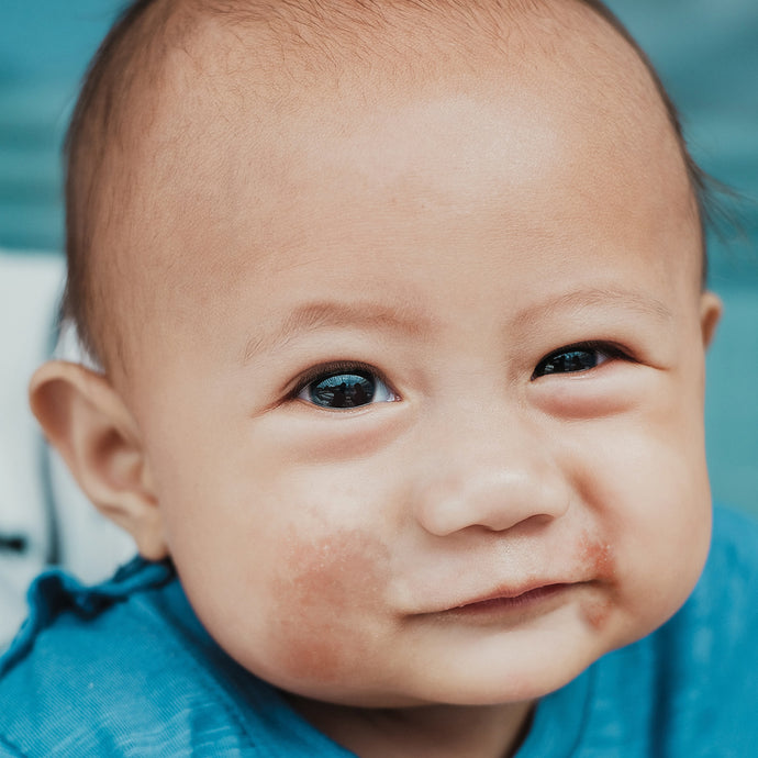 Dermatitis atópica en bebés y niños. Preguntas y respuestas