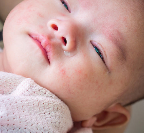 Bebé con un brote de dermatitis atópica en la cara - Mustela España - 1