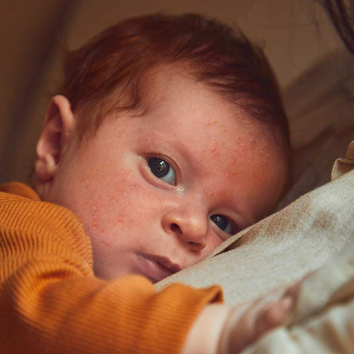 Acné bebe - Mustela España - 1