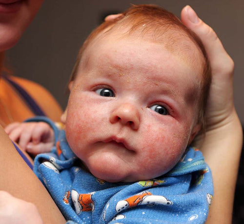 Bebé con eccema en la cara por la dermatitis atópica. - Mustela España - 1
