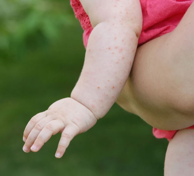 ¿Cómo prevenir los brotes de dermatitis atópica en los niños?