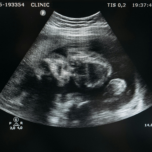 ecografía bebe para saber su sexo - Mustela España - 1